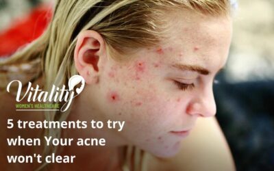 5 Amazing Treatments To Try When Your Acne Won’t Clear
