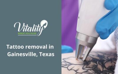 Tattoo Removal: Everything You Need To Know