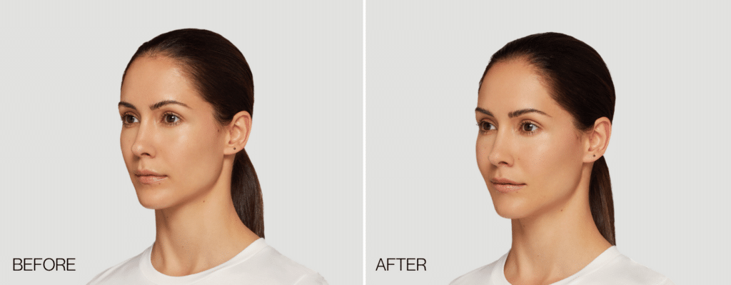 Restylane Contour