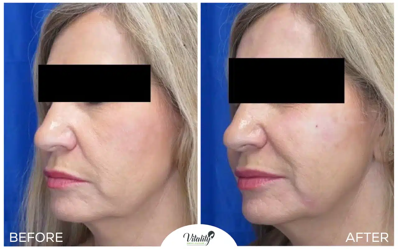 2 cheek filler vitality womens healthcare 67ec173a77180