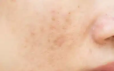 How Many VI Peels Do I Need to Fade Dark Spots?