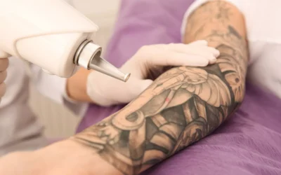 What to Expect After Tattoo Removal